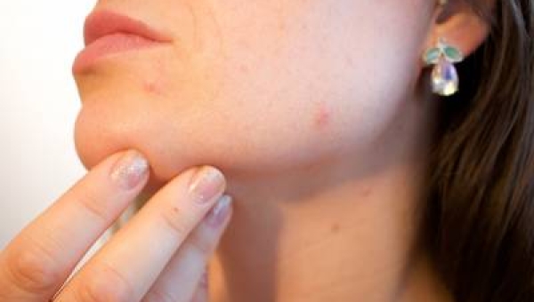 Soffrire di acne