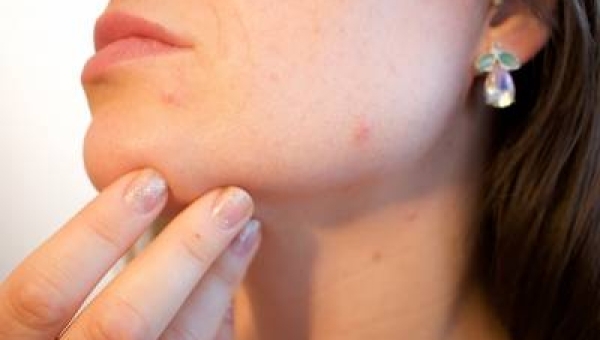 Soffrire di acne